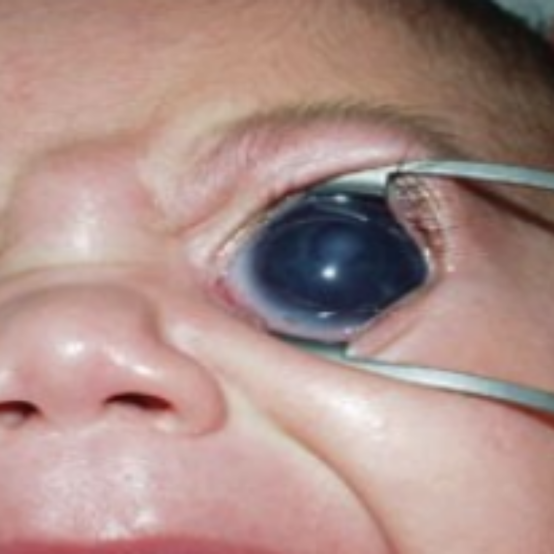 Bebeklerde Göz Büyüklüğü