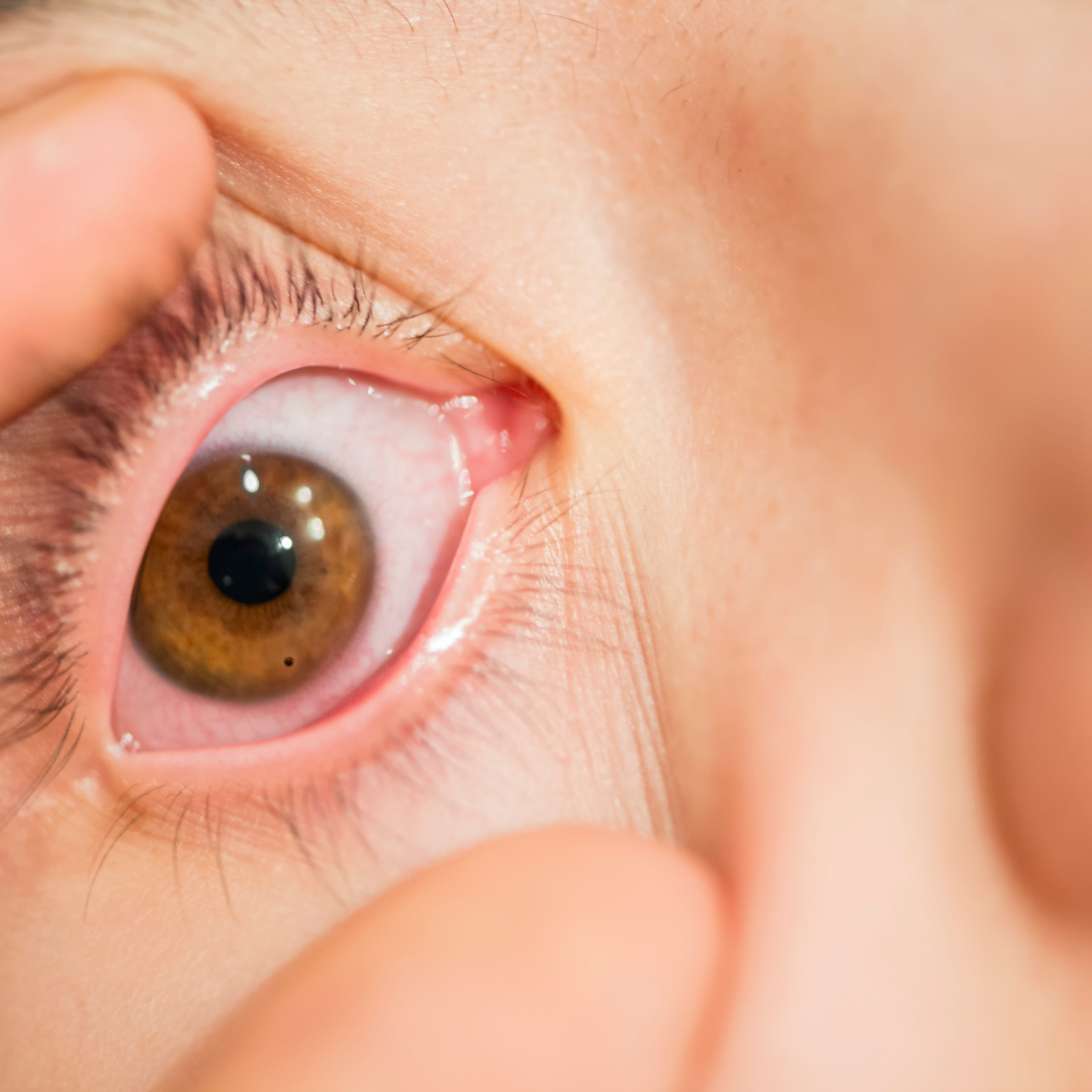 Göz Yaralanmaları Yazın Artıyor Basit Önlemlerle Gözlerinizi Koruyun 