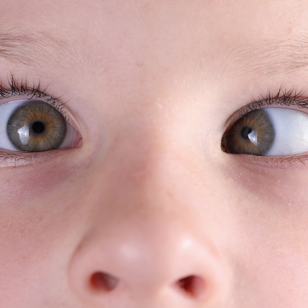 Çocuklarda Şaşılık ve Göz Tembelliği Tedavisinde Erken Tanı ve Tedavi Çok Önemli