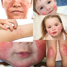 Dermatit