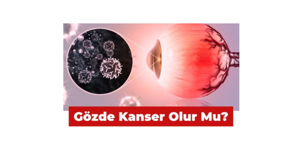 Gözde kanser olur mu?