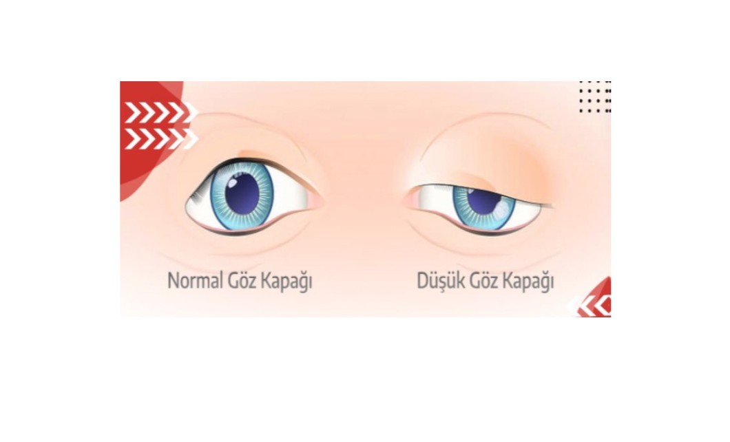 Botoks uygulaması sonrası göz kapağında düşme (Pitozis) gelişebilir.