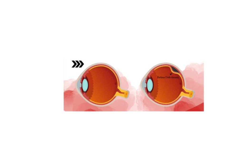Gözde şimşek çakması, retina dekolmanının habercisi olabilir!